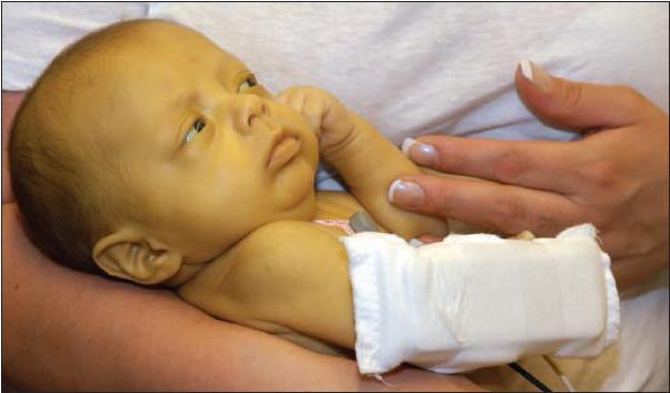 أعراض اليرقان عند الأطفال حديثي الولادة: أنواع وعلامات التهاب الكبد